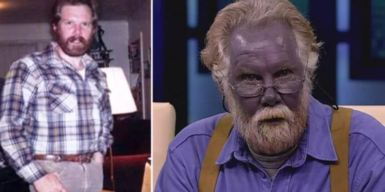 İlaçla Şirin Baba’ya dönüştü! Mavi deri hastası Paul Karason’un inanılmaz hikayesi…