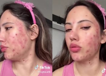 Sivilce maskesi yüzünden acillik olan TikTok fenomeni