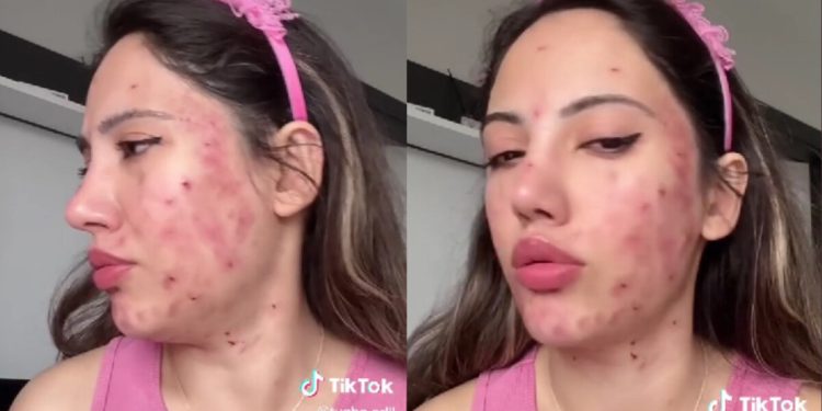 Sivilce maskesi yüzünden acillik olan TikTok fenomeni