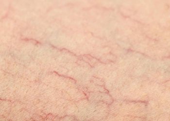 Anjiyodan kurtarıyor! Her gece 1 bardak için, damar tıkanıklığını bitirin…