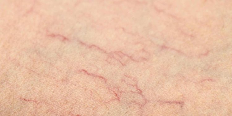 Anjiyodan kurtarıyor! Her gece 1 bardak için, damar tıkanıklığını bitirin…