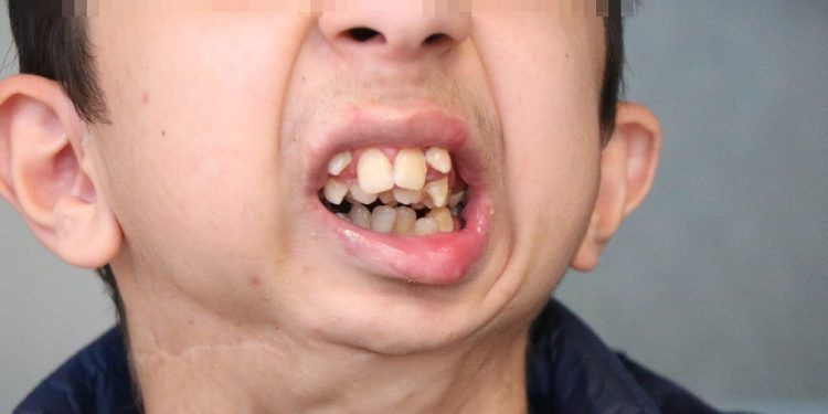 Samsun’da kemik problemleri yaşıyor! Alt çenesi yok…